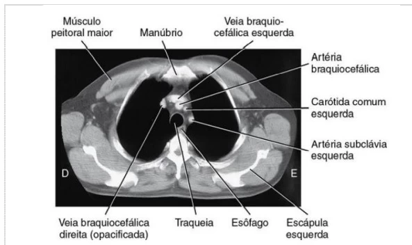 tomografia computadorizada de tórax